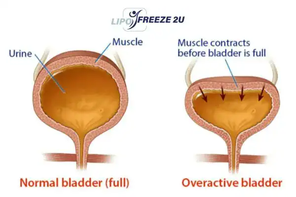 diagram of overactive bladder treatment Hertford
