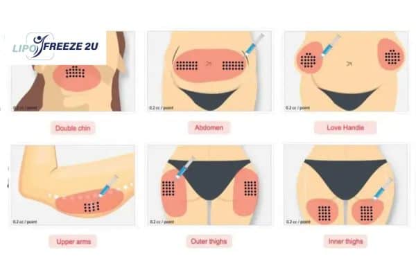 Benefits of Choosing Aqualyx for Fat Reduction Hertford