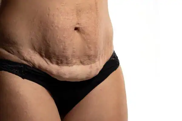 loose skin after weight loss injections Hertford