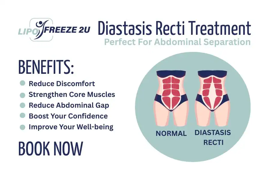 Benefits of body toning treatment Hertford for Diastasis recti