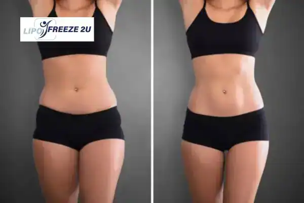 How Can LIPO FREEZE 2U Support Your Post-Pregnancy Body Recovery Hertford?