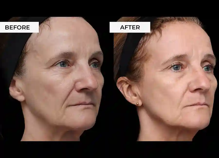 How Many RF Microneedling Sessions Will You Need to See a Difference Hertford?