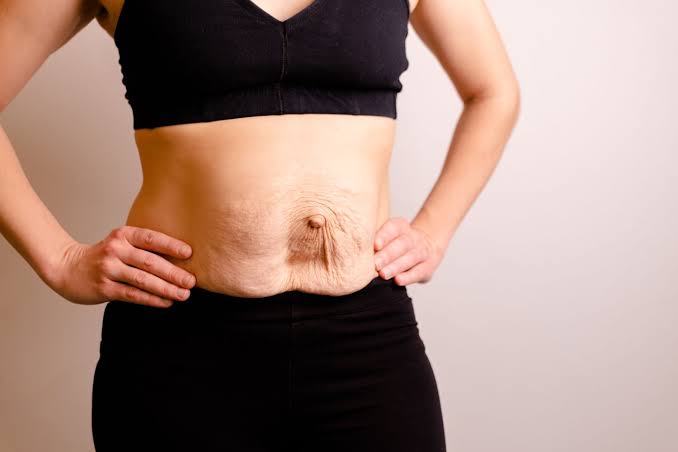Is Surgery Really the Only Way to Repair Diastasis Recti Hertford?